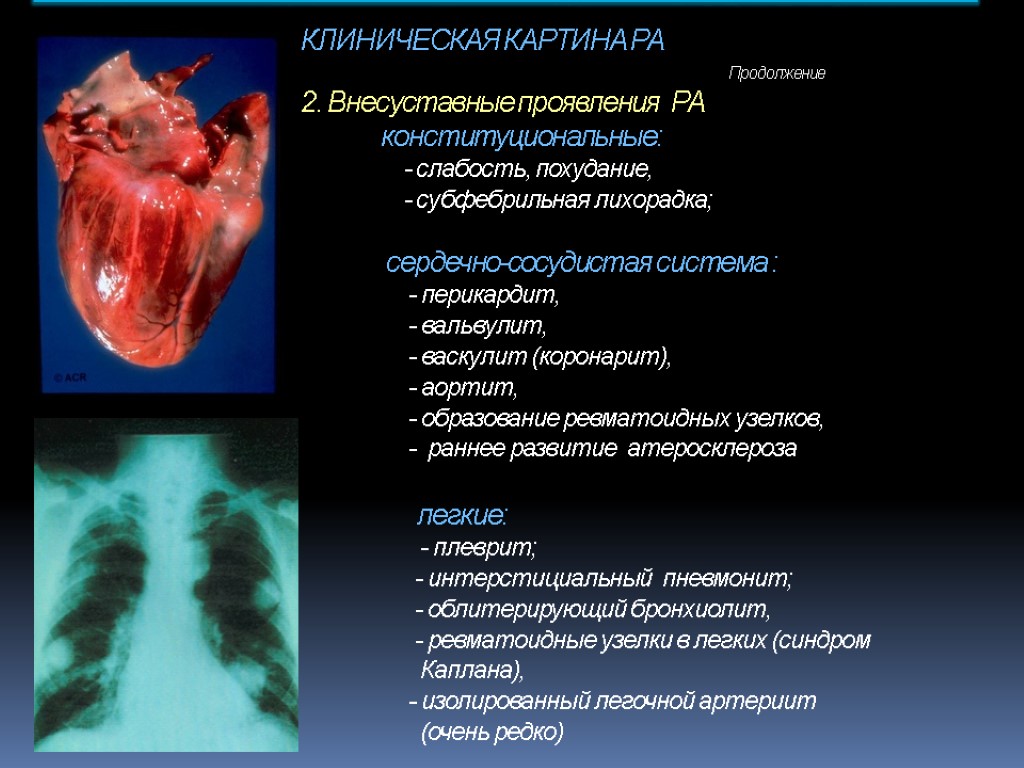 КЛИНИЧЕСКАЯ КАРТИНА РА Продолжение 2. Внесуставные проявления РА конституциональные: - слабость, похудание, - субфебрильная